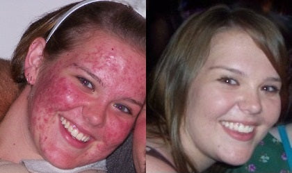 Clear Skin Pack for Oily & Acne-Prone Skin